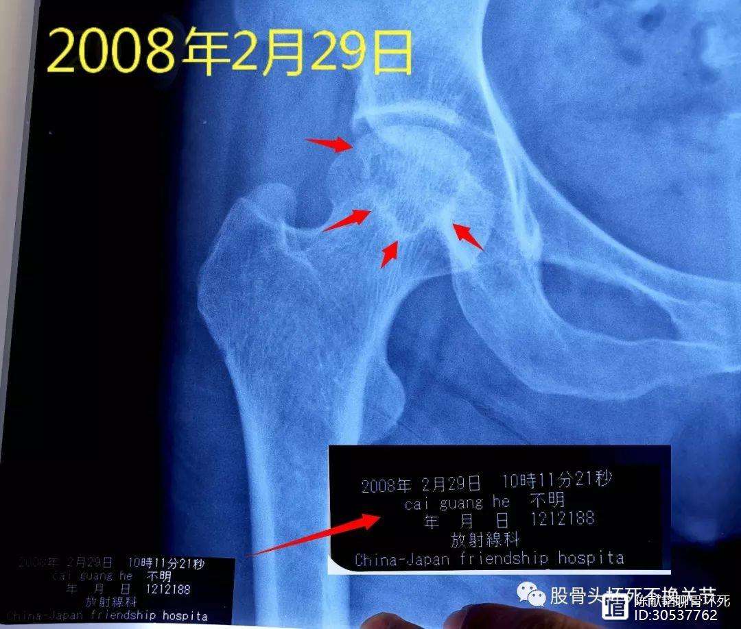 抚州人工骨头医保报销多少(人工骨头医保报销多少比例)